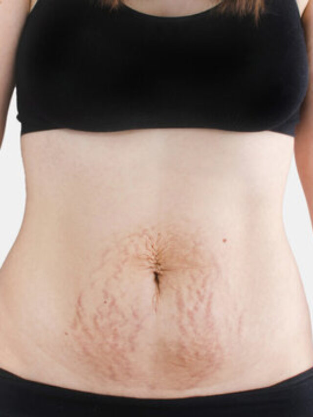 How to remove blackness of stomach after delivery
